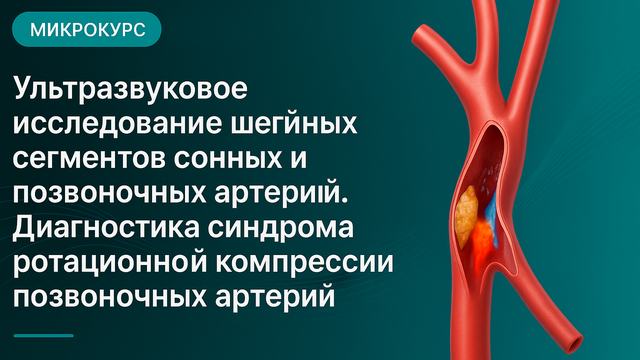 Ұйқы және омыртқа артерияларының мойын сегменттерінің ультрадыбыстық зерттеуі. Омыртқа артерияларының ротациялық компрессия синдромын диагностикалау